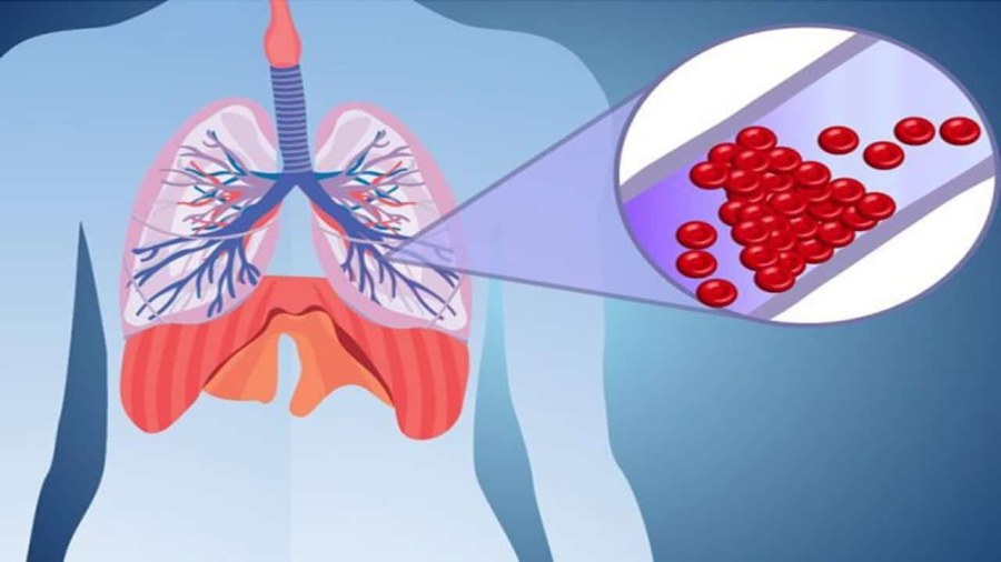 Pulmoner Emboli Nedir? Kan Pıhtıları Akciğeri Nasıl Engeller?